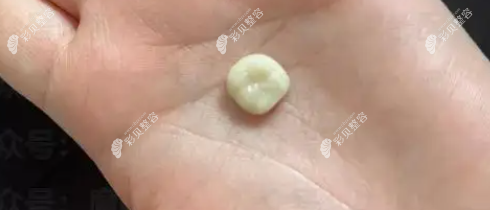 吃大白兔把牙冠粘掉了 吃大白兔把牙冠粘掉了