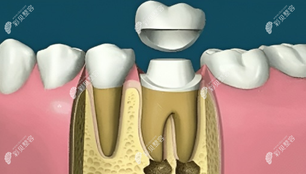根管治疗结束后佩戴牙冠