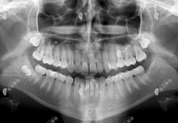 根管治疗需要拍多次x光片进行对比哦