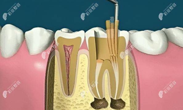 根管充填详细步骤图解