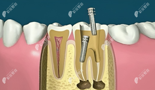 什么是根管打桩