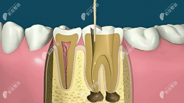 根管冲洗过程图片