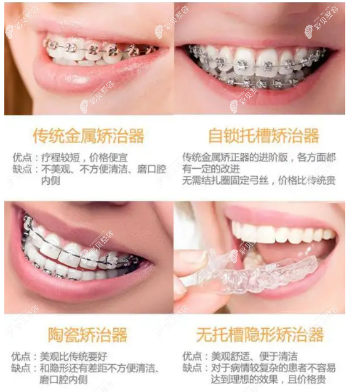 牙齿矫正手术