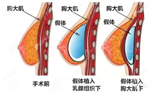 假体隆胸时假体的放置位置