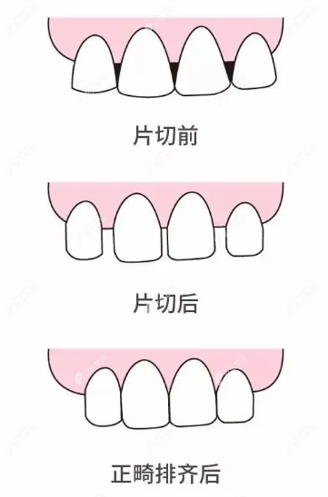 牙齿片切正畸