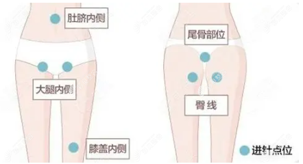 哈尔滨瑞丽整形的张旭光医生做大腿吸脂的进针点位