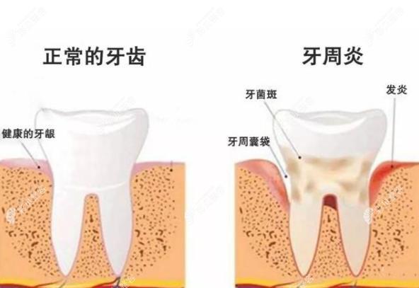 牙周炎容易引发牙龈退缩情况