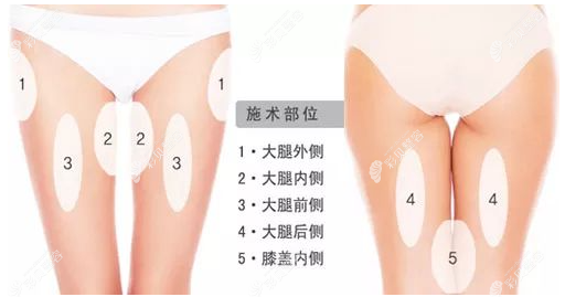 哈尔滨大腿吸脂医生排名前三的是常维国、张旭光、周彩莲