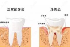 牙龈萎缩是什么原因导致的？是不是身体哪里出问题了呀