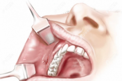 脸部下颌角整形手术后注意事项有哪些？