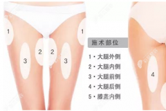 哈尔滨大腿吸脂医生排名前三的是常维国、张旭光、周彩莲