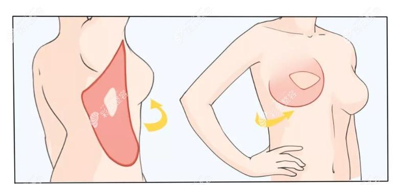 自体乳房重建前后对比照片