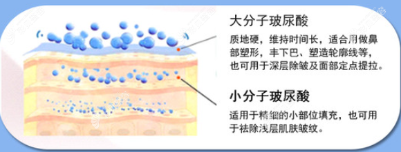 不同分子玻尿酸的填充部位