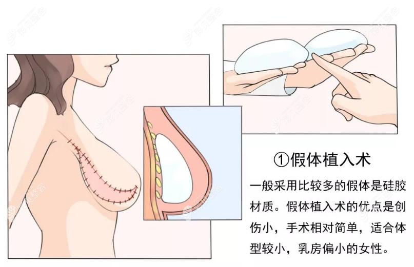 假体乳房重建的优点和适应人群