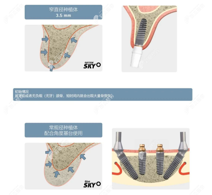 德国sky种植牙价格是多少钱一颗