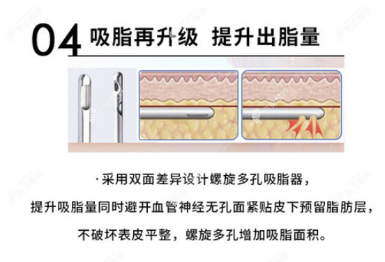 深圳富华大腿吸脂好吗