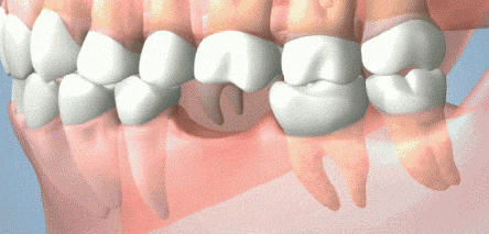 单颗牙缺失的影响