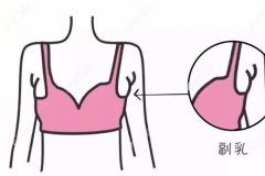 吸脂去副乳术后注意事项:多久能运动/能侧身睡吗都有讲