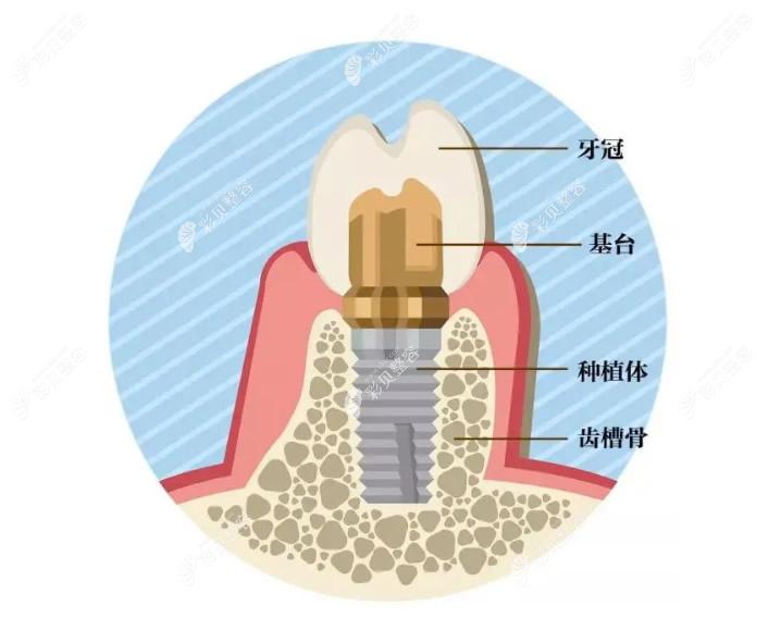 种植牙由牙冠基台和植体三部分组成