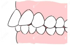 腺样体肥大牙齿突出可以矫正吗？可以，等到14岁正畸比较好