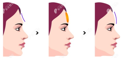 假体丰额头怎么样