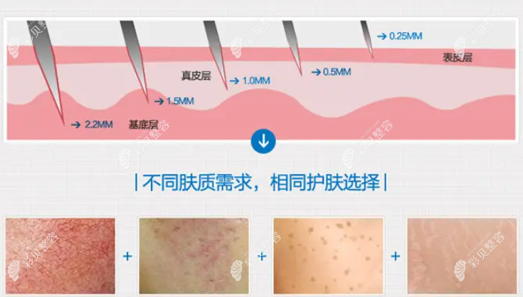 黄金微针不同肤质治疗深度