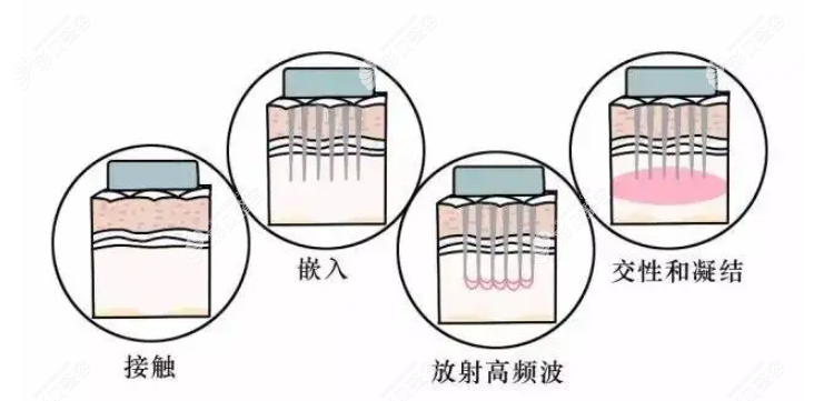 微针作用原理