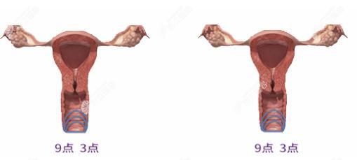 3D生物束带紧缩术操作示意图