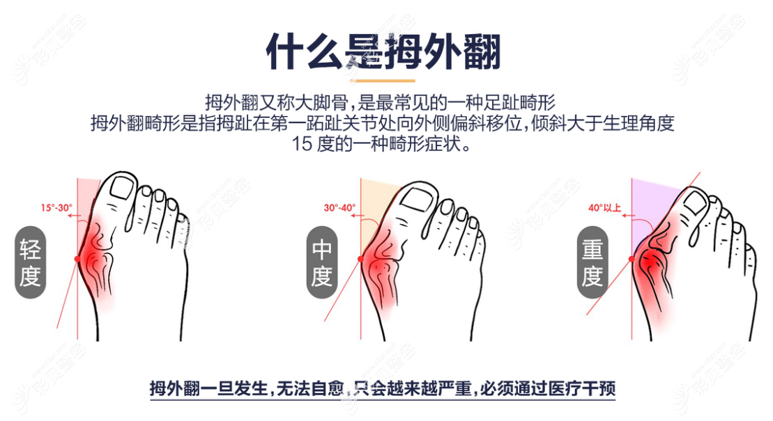 成人拇外翻矫正方法对比:微创手术比保守治疗和传统手术好