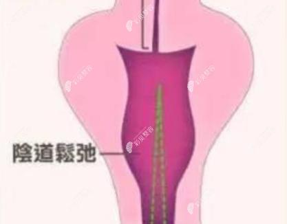 做完紧缩手术后悔了,是因做3D生物束带三个月没紧的原因吗?