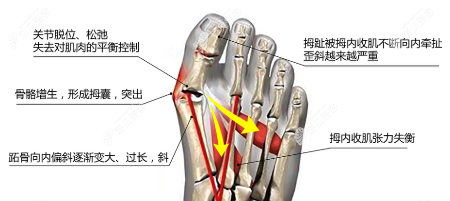 拇外翻形成原因及过程图解