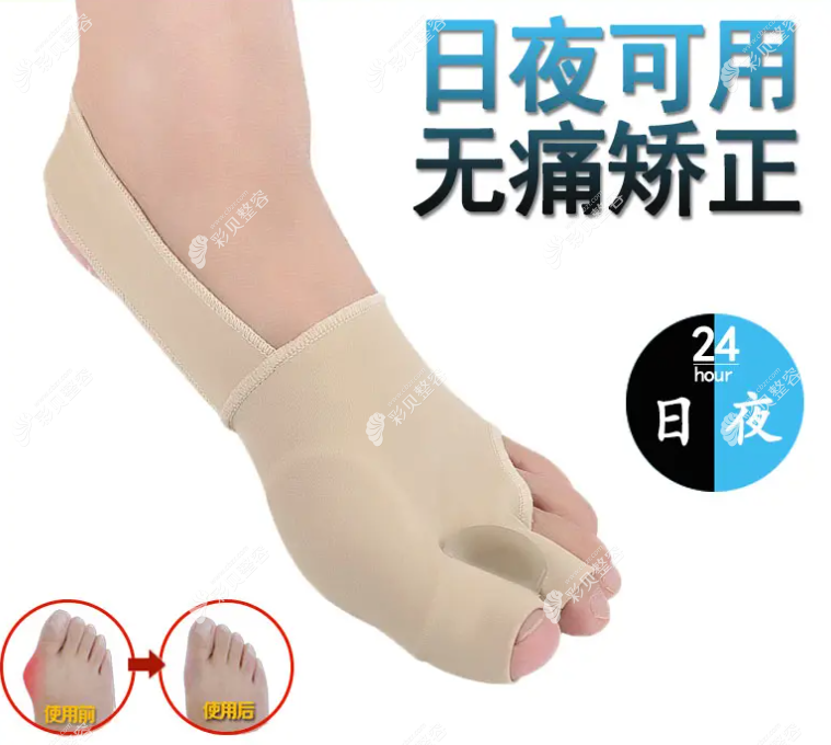 成人治疗拇外翻使用矫正器怎么样