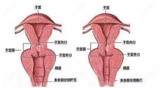 3D生物束带紧缩术挺好的