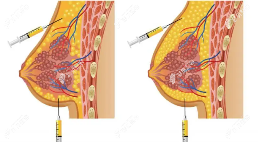自体脂肪丰胸填充部位