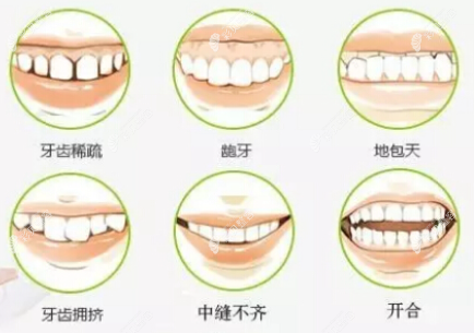 什么样的牙齿可以做舌侧矫正