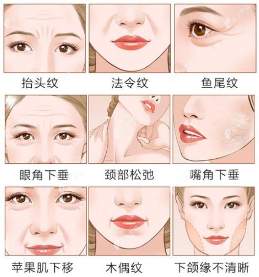 热玛吉适合人群有哪些 热玛吉适合人群有哪些