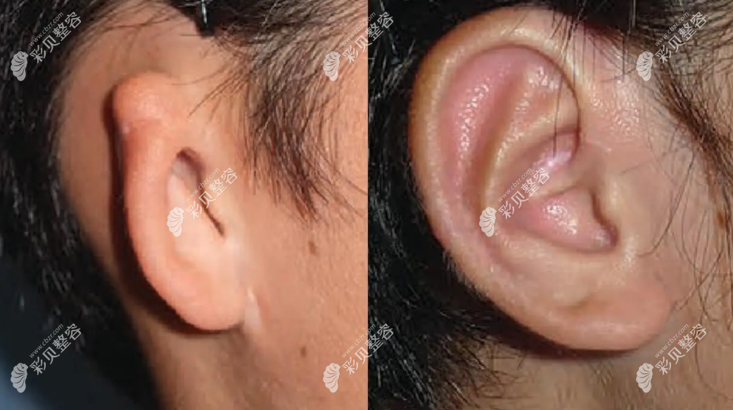 取肋骨做耳朵对身体有影响吗，取肋骨做耳朵的后遗症是...