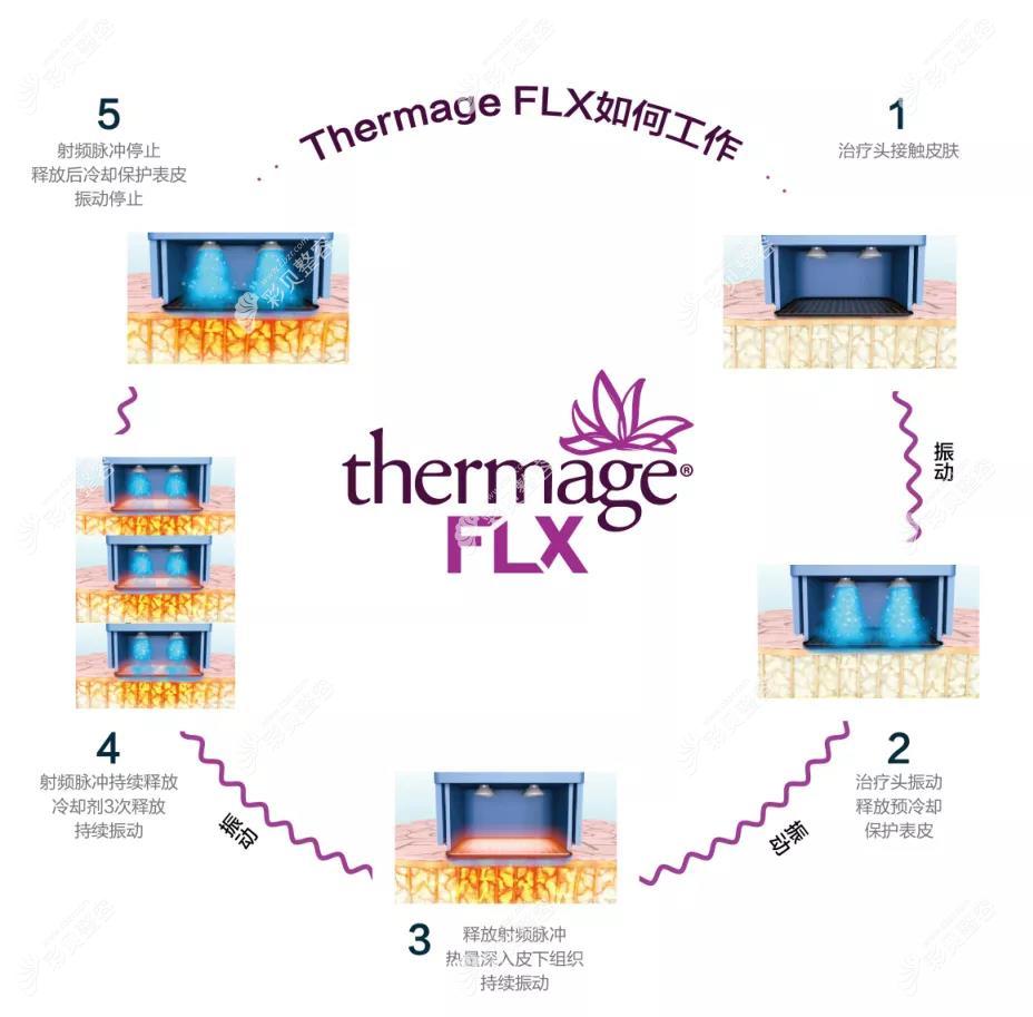 5代热玛吉除皱工作流程图 5代热玛吉除皱工作流程图
