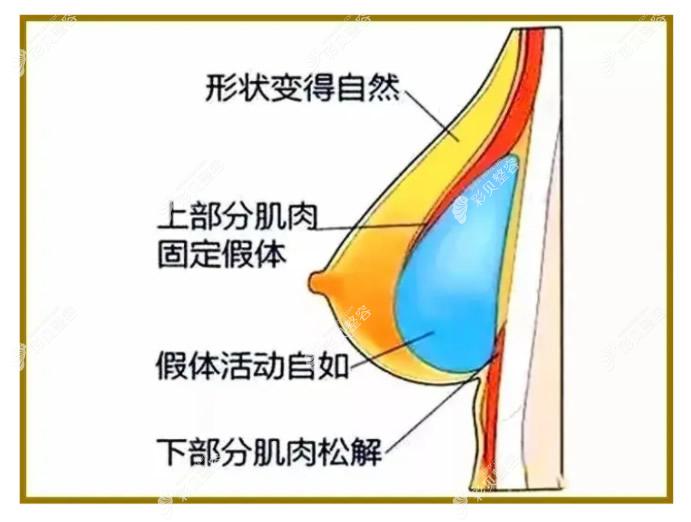 水滴形假体隆胸效 果图m.cbzr.com