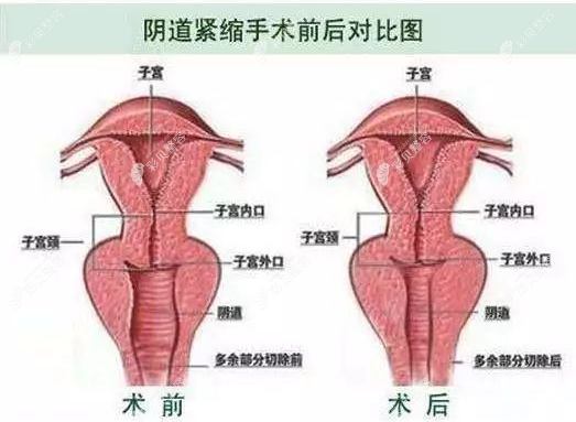 缩阴手术前后对比