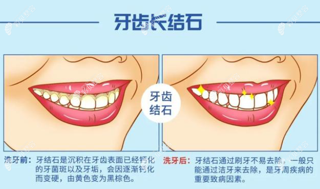 牙齿结石前后对比cbzr.com