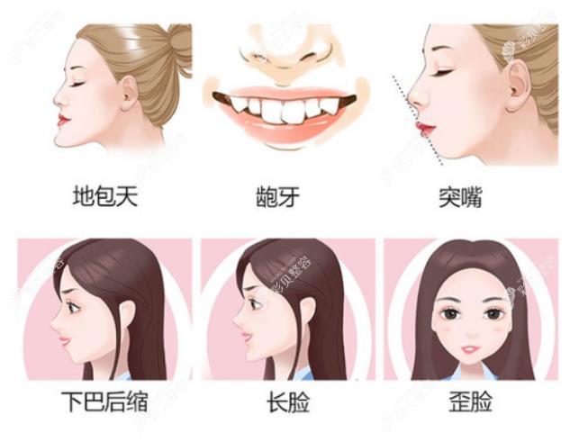 正颌手术适合人群有哪些