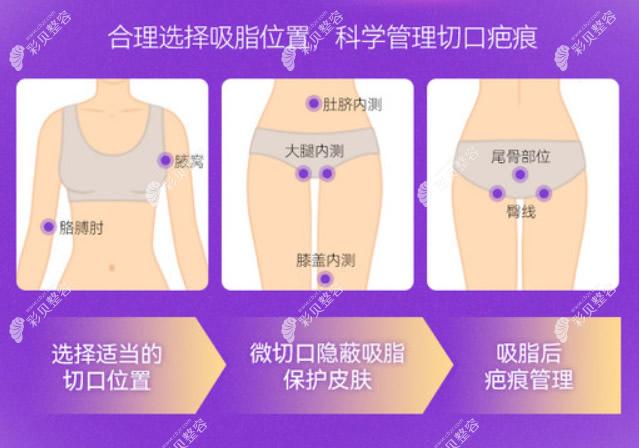 北京润美玉之光吸脂部位及技术优势m.cbzr.com