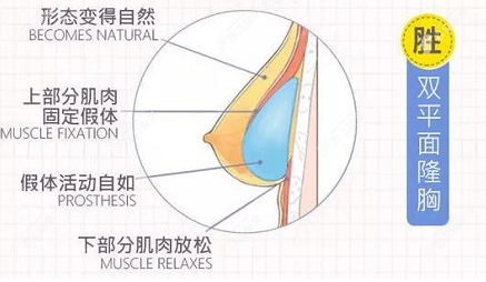 双平面隆胸优势