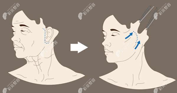 正常拉皮手术前后对比图