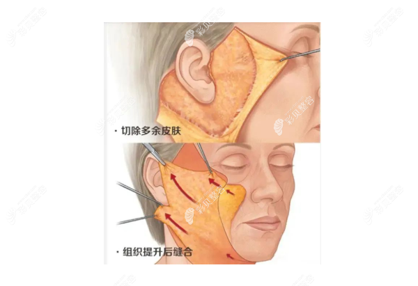 拉皮手术过程图解