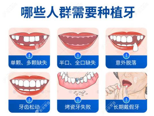 合肥标点口腔做种植牙的类型