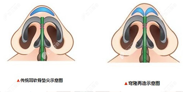 穹隆再造示意图cbzr.com