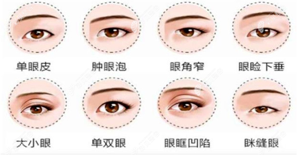 陈亮医生双眼皮可以改善的症状