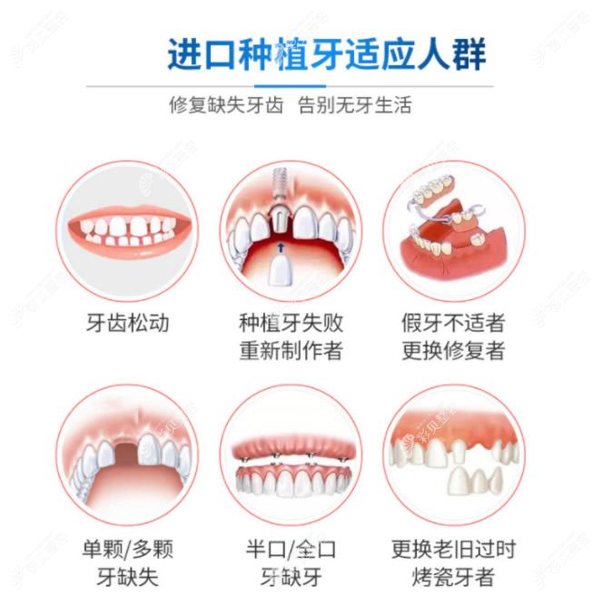 进口种植牙适合哪些人做